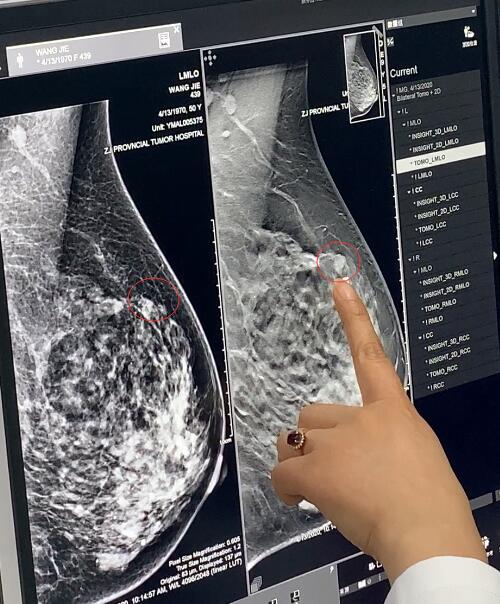 传统乳腺X线检查（左）与数字化乳腺断层融合摄影检查结果（右）对比，肿块（红圈位置）轮廓更清晰。
